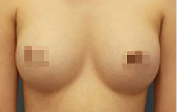After-BREAST