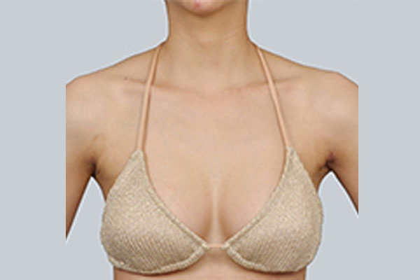 After-BREAST