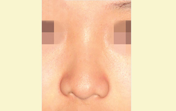 Before-Nose
